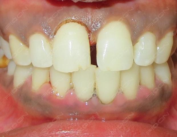 Gingivoplasty Using Diode Laser