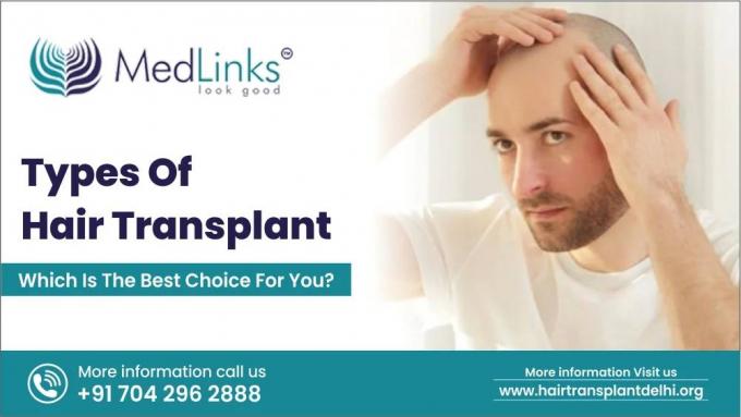 Types Of Hair Transplant | Medlinks