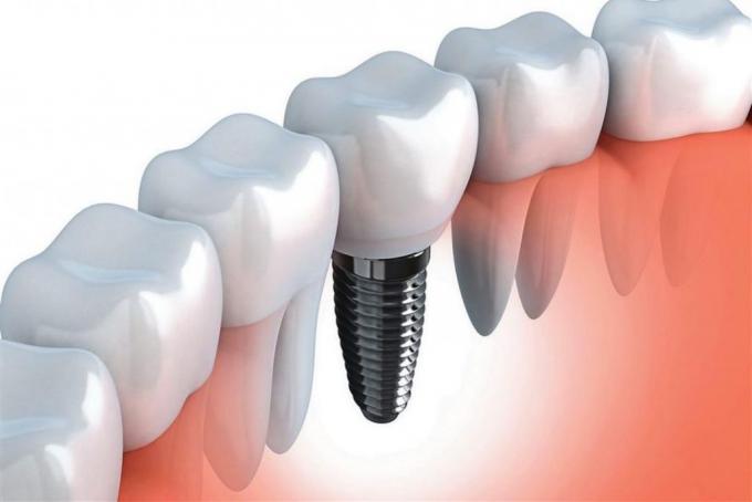 Dental Implants Adelaide