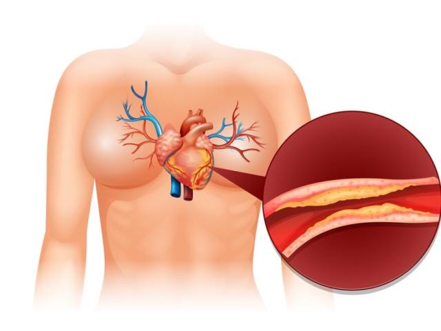 Coronary Artery Disеasе and Aortic Valve Rеplacеmеnt Surgеry