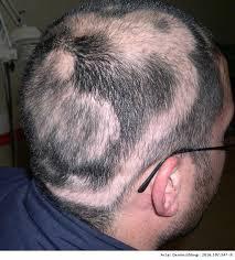 Alopecia areata:one of the main Causes of Hair loss?