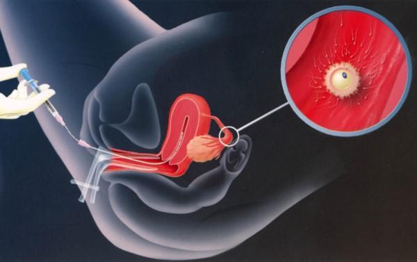 Dynamic Fertility: IUI Treatment India | Top IUI Clinic in India