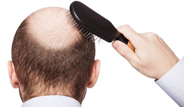 Home Remedies for Baldness | टक्कल पडण्याच्या समस्येवर करा घरगुती उपचार | Maharashtra Today