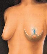 Breast Lift Surgery in Mexico