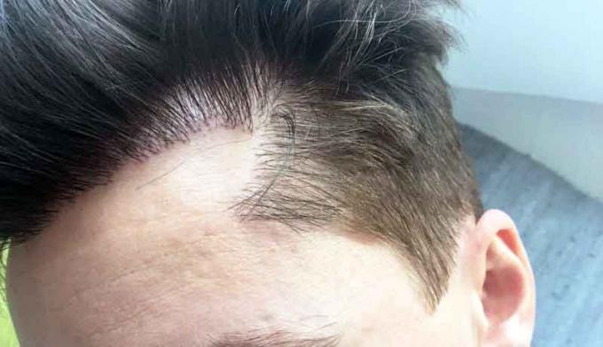 Does FUE Hair transplant leave scars? - American Article