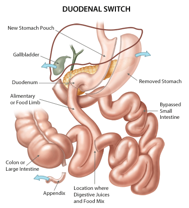  Duodenal Switch Surgery in India - Healing Touristry