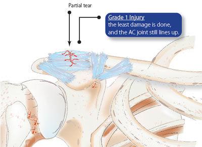  Acromioclavicular Joint Repair Surgery in India - Healing Touristry