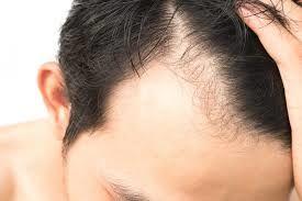 Best Hair Transplant in Dubai, UAE Clinic - Dynamic Hair Transplant