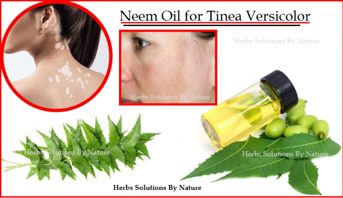Neem Oil for Tinea Versicolor Natural Remedies and Natural Essential Oils - Herbs Solutions By Nature