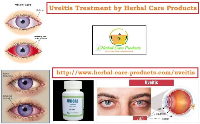 Uveitis Natural Remedies | Symptoms Causes and Natural Home Treatment - Herbal Care Products