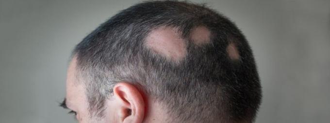 PRP Treatment for Hair Loss in Dubai &amp; Abu Dhabi - PRP Injections | Hair Transplant Dubai