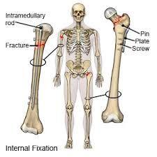  Internal Fixation of Fractures Surgery in India - Healing Touristry