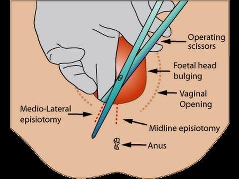  Labiaplasty (Labia Rejuvenation) Surgery in India - Healing Touristry