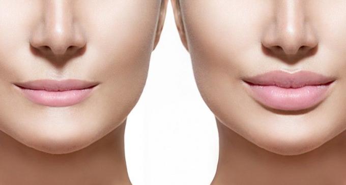 Lip Augmentation Treatment in India | Healing Touristry