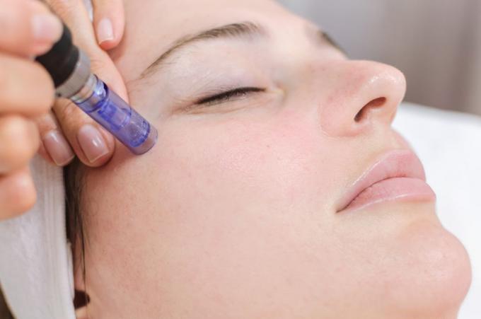 4 Amazing Benefits of Microneedling - 