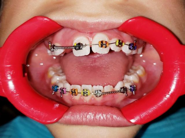 Early Underbite Correction Can Help Avoid Surgery - Affordablebraces's Pad