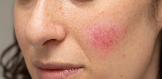 A Complete Guide To Rosacea