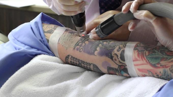 Permanent Tattoo Removal | Tattoo Removal in Tirupati