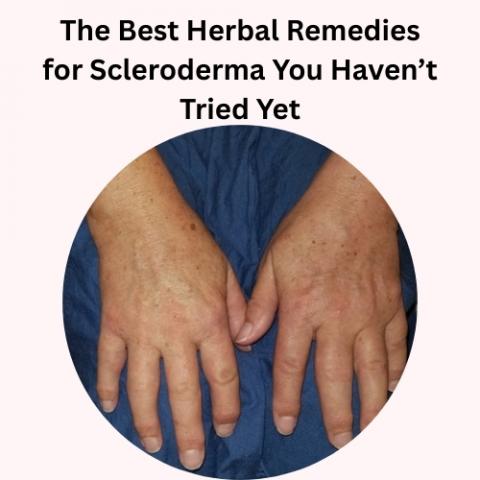 Herbal Care Products | Natural Herbal Remedies Information : The Best Herbal Remedies for Scleroderma You Haven&#8217;t Tried Yet