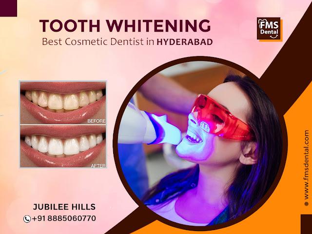 Tooth Whitening at FMS International Dental Center