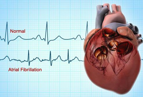 11 Natural Treatments for atrial fibrillation - Herbal Care Products