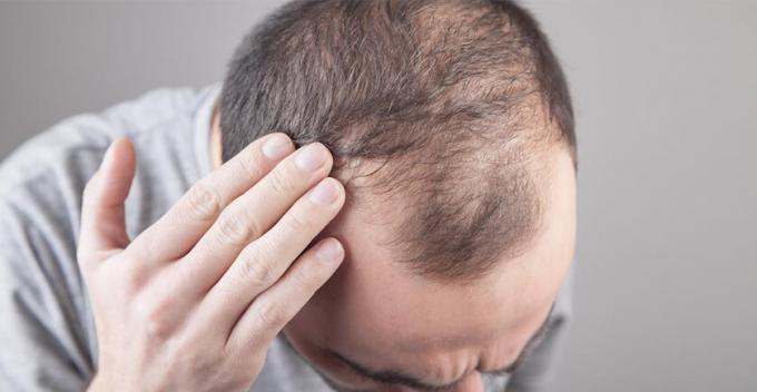 Which Hair Transplant Method is Best?