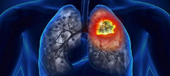 What Are The Types Of Blood Cancer | Cancer Consult ndia