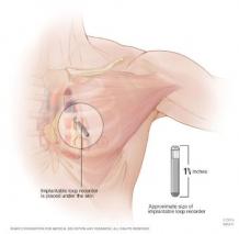 Loop Recorder Insertion in Colorado - Denver - Thornton - AHVC