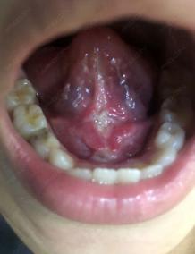 Management of Tongue-Tie/Ankyloglossia - A Surgical Procedure with Dental Laser