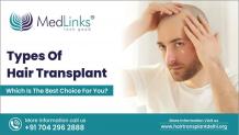 Types Of Hair Transplant | Medlinks