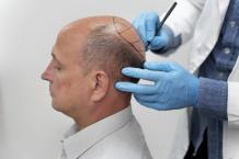 FUE Hair Transplant - Dr. Shivam&#039;s Hair Clinic