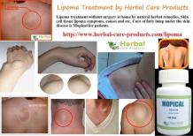 10 Natural Home Remedies for Lipoma - Herbal Care Products