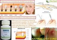 14 Herbal Cures for Sebaceous Cyst - Herbal Care Products