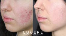 What Is Adult On-Set Acne and How Can It Be Treated? | HubPages