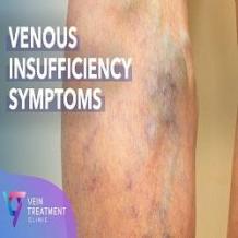 What things make you prone to get spider vein?