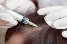 Hair Transplant Dubai 　Mesotherapy for Hair ReGrowth: Does it Really Work?