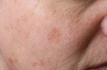 How To Treat Hyperpigmentation?