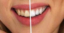 Comparison of Laser Teeth Whitening and LED cold light bleaching