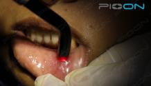 Applications of Low-Level laser therapy in dental practice