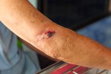 Advanced Mobile Wound Care - Blue Ridge Wound Care