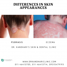 Kandhariclinic: Is It Eczema or Psoriasis? How to Tell the Difference Between the Two Skin Conditions?