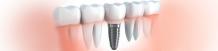 What are Implants &amp; Their Advantages | Dental Implants in Pune, Mukundnagar