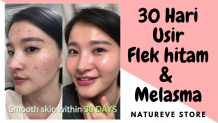  5 Produk Terbaik Untuk Flek Hitam dan Melasma | Natureve Store 