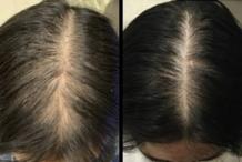 Hair Fall Treatment in Chennai | Cost of Hair Loss Treatment | Dr. Health Clinic