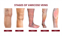 Vein Clinic: What To Expect During The Treatment From A...