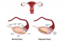 How Does PCOS Lead To Pregnancy Issues?