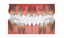 Cost of Full Mouth Dental Implants in India - Dr Motiwala