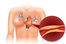 Coronary Angioplasty: Procedure, Benefits And Recovery &#8211; Tefwins