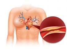 Which is the Best Angioplasty Procedure or Stent?