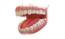 Cost of Full Mouth Dental Implants in India - Dr Motiwala